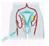 Embolisation procedure